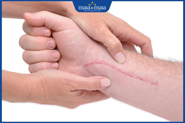 sẹo lồi bị ngứa