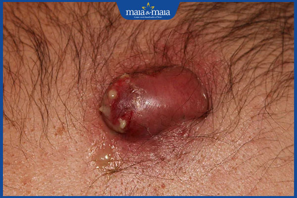 Tiêm sẹo lồi bao lâu thì xẹp? Bao nhiêu mũi thì cải thiện? 3 sẹo lồi bị nhiễm trùng