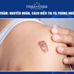 sẹo lồi bị thâm