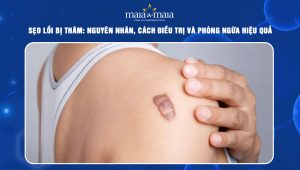 sẹo lồi bị thâm