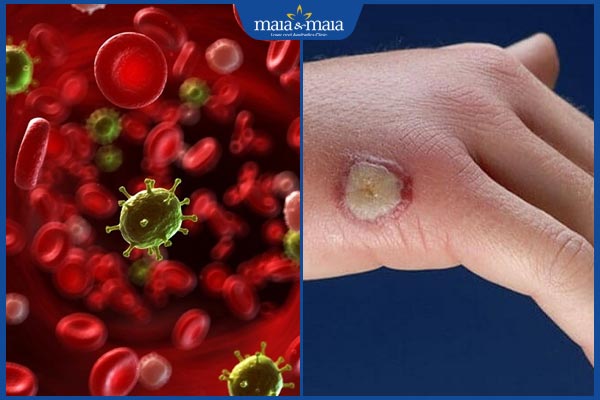 Sẹo lồi có mủ do đâu? Dấu hiệu nhận biết và cách điều trị 3 sẹo lồi có mủ nguy hiểm