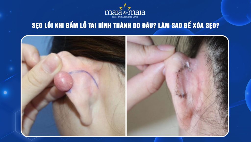 sẹo lồi khi bấm lỗ tai