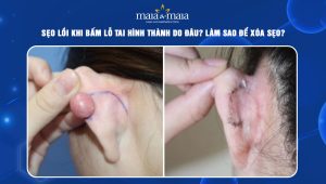 sẹo lồi khi bấm lỗ tai