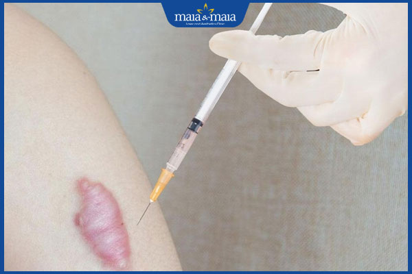 Tiêm sẹo lồi bao lâu thì xẹp? Bao nhiêu mũi thì cải thiện? 2 sẹo lồi không xẹp ngay sau tiêm