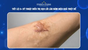 sẹo lồi lâu năm