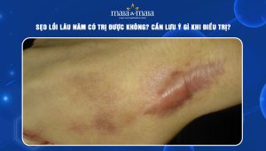 sẹo lồi lâu năm có trị được không