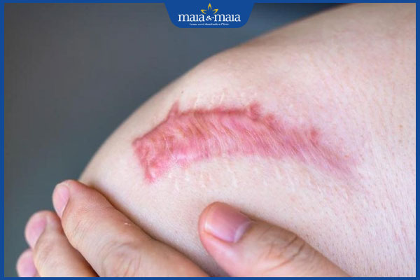 Đặc điểm sẹo lồi lâu năm và các phương pháp điều trị hiệu quả 2 sẹo lồi lâu năm sẫm màu