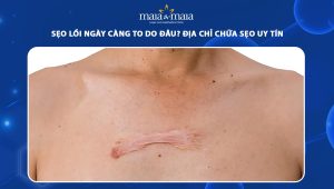 sẹo lồi ngày càng to