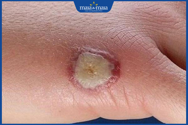 Sẹo lồi có mủ do đâu? Dấu hiệu nhận biết và cách điều trị 2 sẹo lồi nhiễm trùng