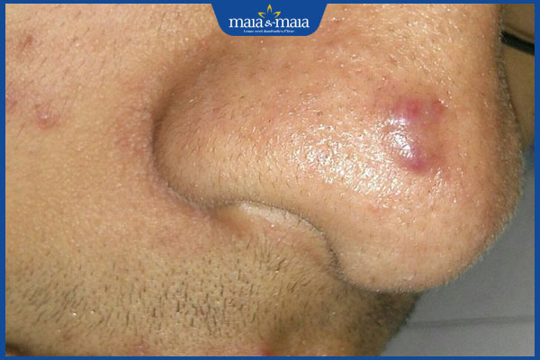 Trị sẹo lồi bằng nitơ lỏng có đắt không? Hiệu quả ra sao? 3 sẹo lồi nhỏ nhạt màu