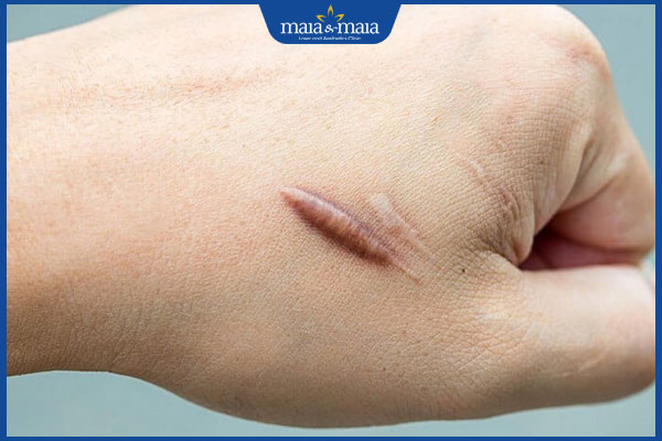 Tiêm sẹo lồi có tốt không? Quy trình và chi phí thực hiện 3 sẹo lồi nhỏ