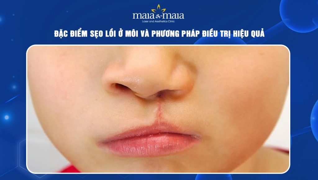 Đặc điểm sẹo lồi ở môi và phương pháp điều trị hiệu quả 1 Sẹo lồi ở môi