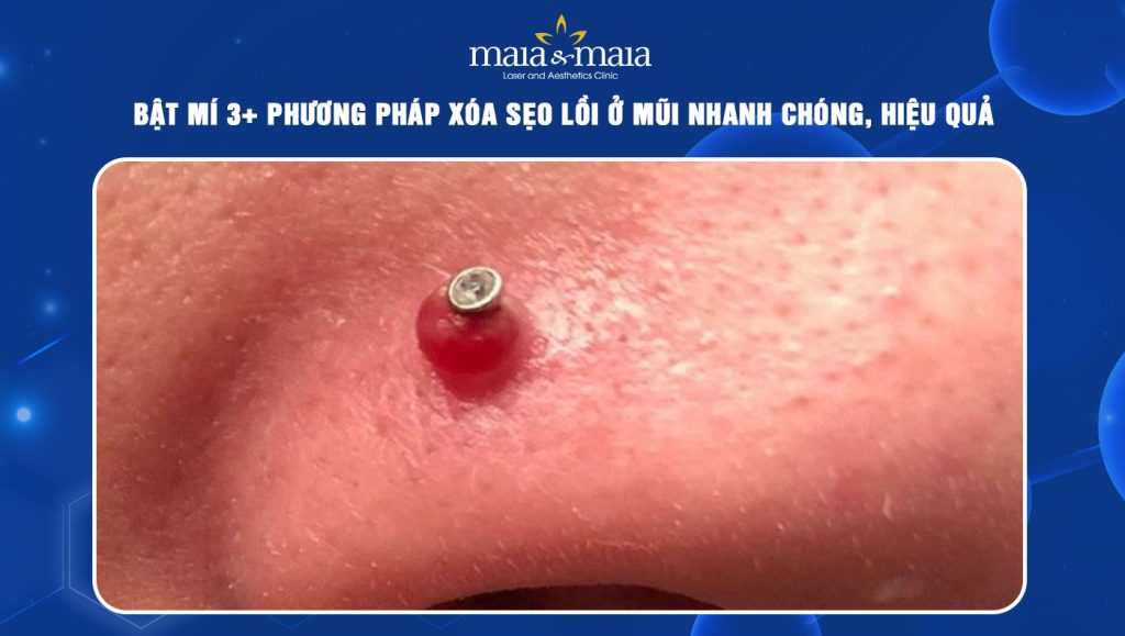 Bật mí 3+ phương pháp xóa sẹo lồi ở mũi nhanh chóng, hiệu quả 1 sẹo lồi ở mũi
