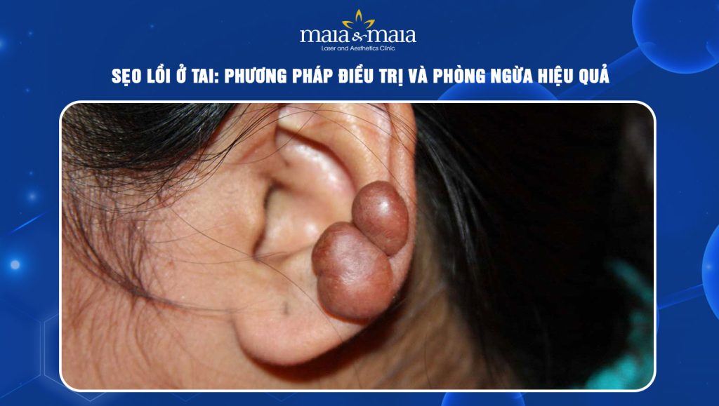 Sẹo lồi ở tai: Phương pháp điều trị và phòng ngừa hiệu quả 1 Sẹo lồi ở tai