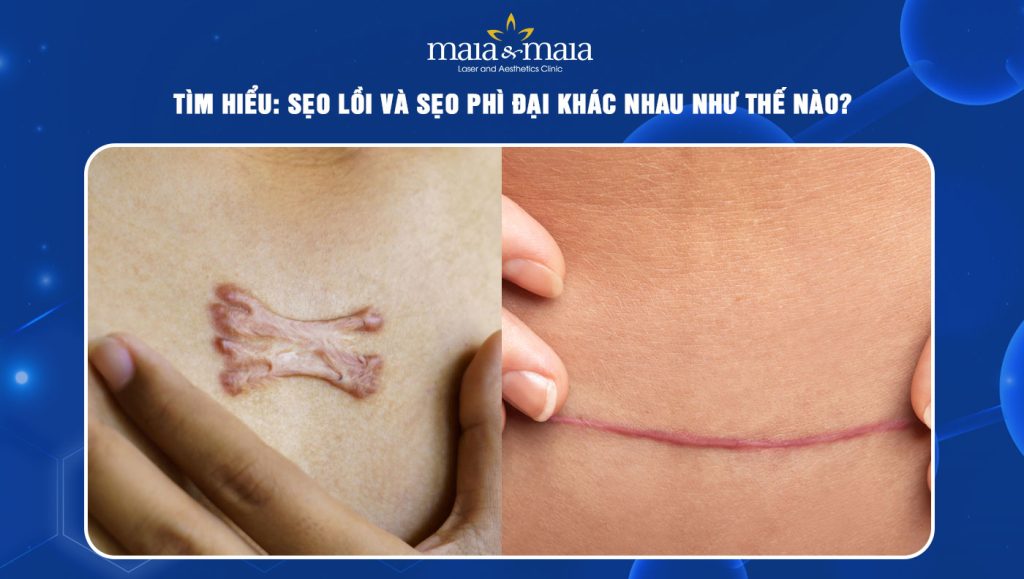 Giải đáp nhanh: Sẹo lồi và sẹo phì đại khác nhau như thế nào? 1 sẹo lồi và sẹo phì đại