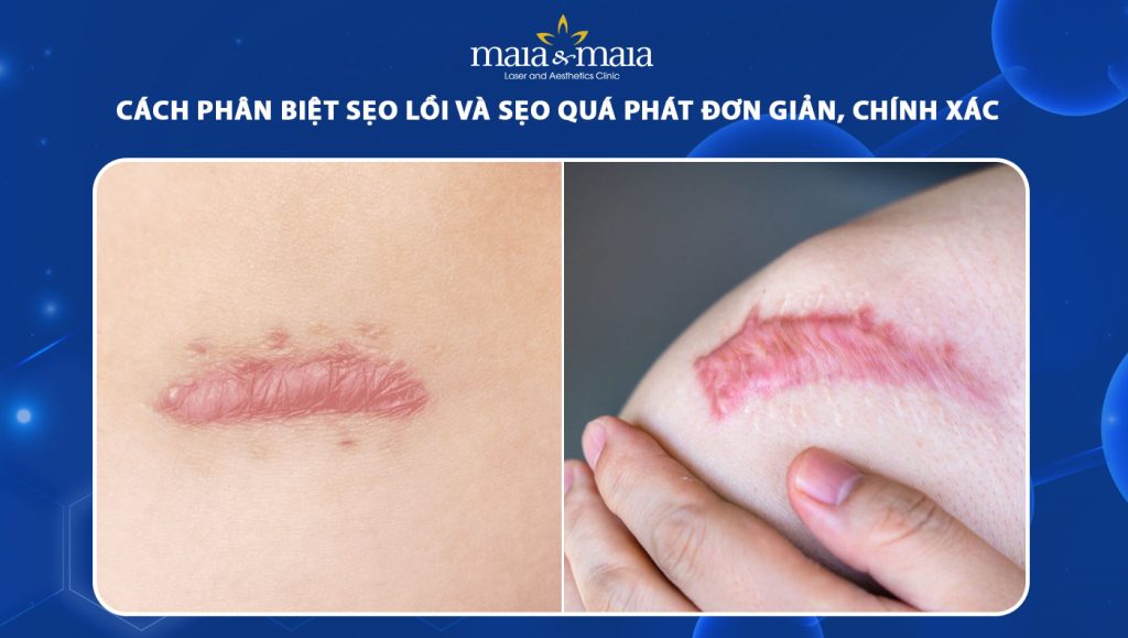sẹo lồi và sẹo quá phát