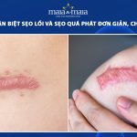 sẹo lồi và sẹo quá phát