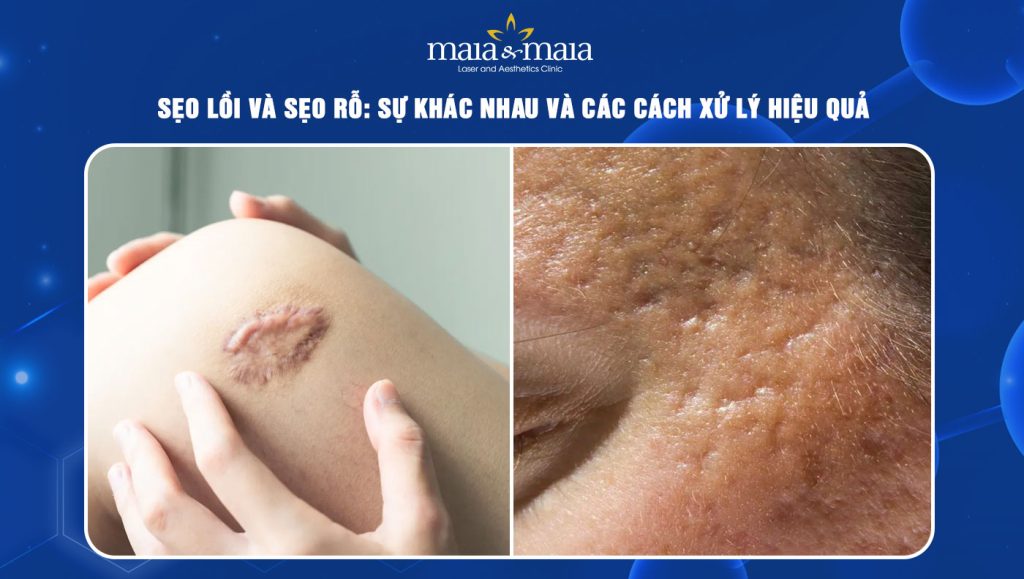 sẹo lồi và sẹo rỗ