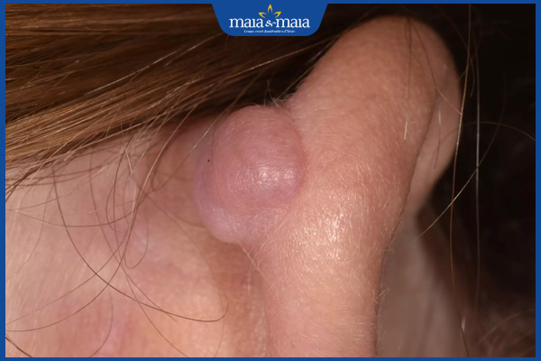 Sẹo lồi ở tai: Phương pháp điều trị và phòng ngừa hiệu quả 3 sẹo lồi vành tai