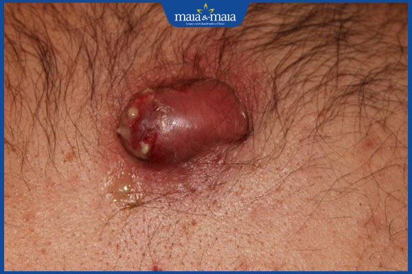 Sẹo lồi bị đau do đâu? Cách giảm đau do sẹo lồi tại nhà 3 sẹo lồi viêm