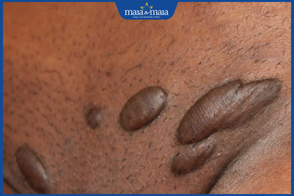 Sẹo lồi ở vùng kín do đâu? Phương pháp điều trị hiệu quả 2 sẹo lồi vùng nhạy cảm