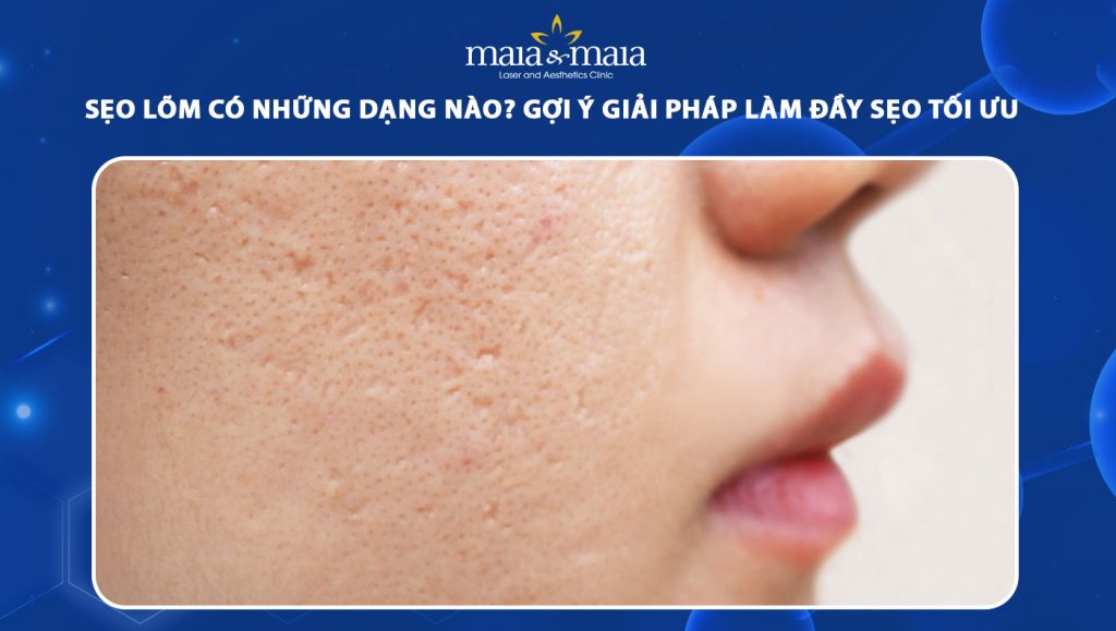 Sẹo lõm có những dạng nào? Gợi ý giải pháp làm đầy sẹo tối ưu 1 sẹo lõm