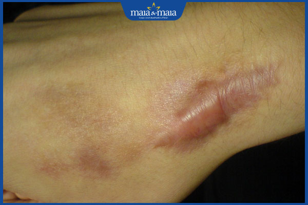 Trị sẹo lồi bằng nitơ lỏng có đắt không? Hiệu quả ra sao? 5 sẹo tái lồi