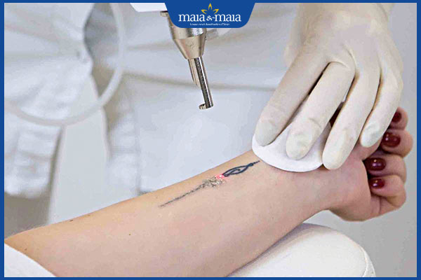 Xóa xăm có để lại sẹo không? Bí quyết chăm sóc tránh sẹo 2 sẹo xấu sau xóa xăm