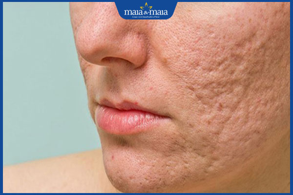 Thực hư hiệu quả dùng thuốc Đông y trị sẹo rỗ tại nhà? 3 seo xo cung