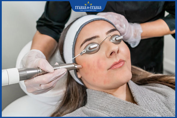 tác động sẹo rỗ