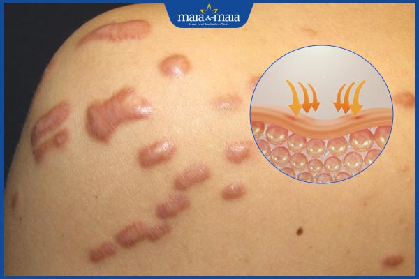 Sẹo lồi ngày càng to do đâu? Địa chỉ chữa sẹo uy tín 2 tăng sinh collagen