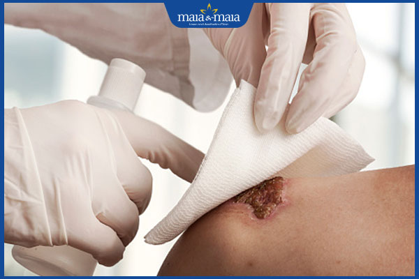 Ăn hàu có bị sẹo lồi không? Có vết thương hở nên kiêng ăn bao lâu? 4 thay băng vết thương