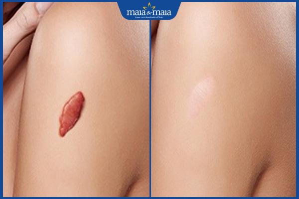 thời gian cải thiện sẹo lồi thâm