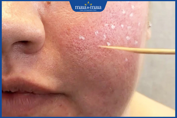 Chấm TCA trị sẹo rỗ có tốt không? Lưu ý sau khi thực hiện 5 thực hiện chấm TCA