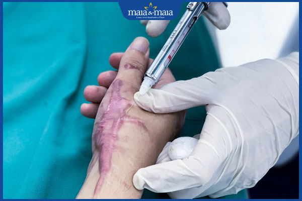 Sẹo lồi ngày càng to do đâu? Địa chỉ chữa sẹo uy tín 5 tiêm corticosteroid trị sẹo lồi