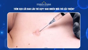 tiêm sẹo lồi bao lâu thì xẹp