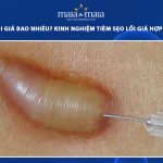 tiêm sẹo lồi giá bao nhiêu