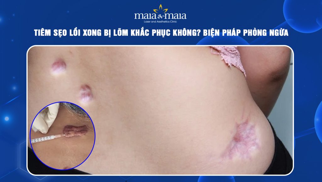 tiêm sẹo lồi xong bị lõm