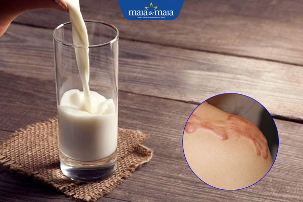 Uống sữa có bị sẹo lồi không? Hướng dẫn sử dụng sữa an toàn 2 uống sữa