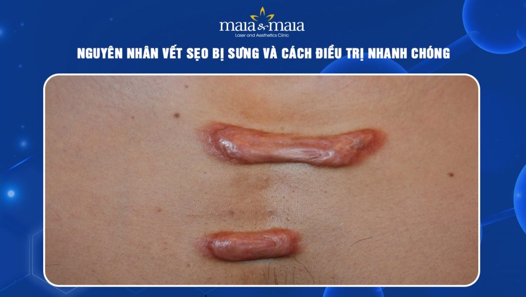 vết sẹo bị sưng