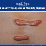 vết sẹo bị sưng