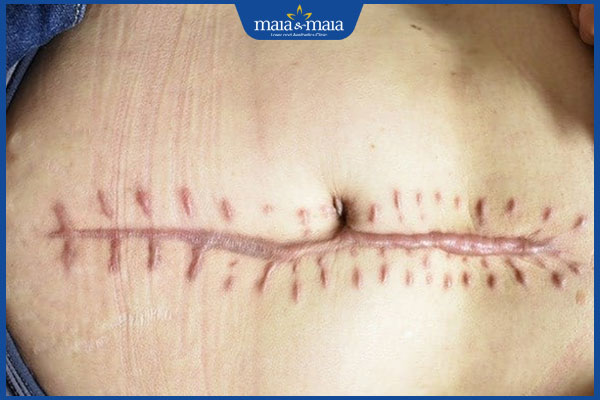vết sẹo lồi sau phẫu thuật