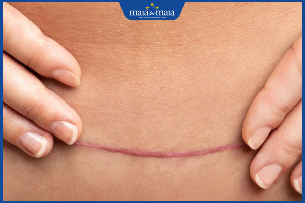 vết thương đẻ mổ