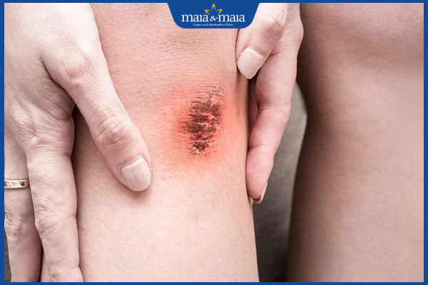 Kiêng ăn gì để không bị sẹo lồi? Thực phẩm nên ưu tiên khi bị thương 2 vết thương đóng mài nhanh chóng