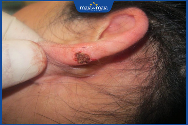 Sẹo lồi ở tai: Phương pháp điều trị và phòng ngừa hiệu quả 2 vết thương ở tai