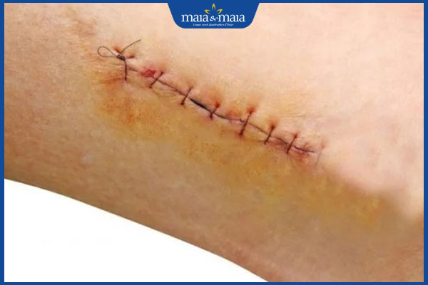 vết thương sâu cần kiêng lâu hơn