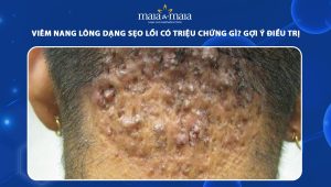 viêm nang lông dạng sẹo lồi