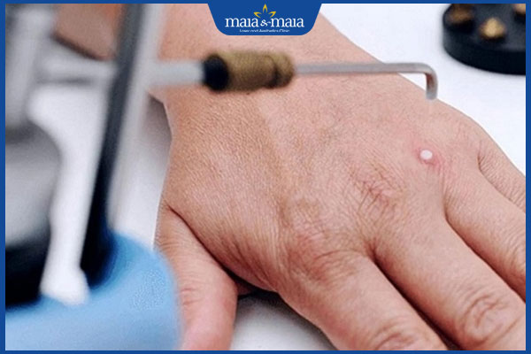 Trị sẹo lồi bằng nitơ lỏng có đắt không? Hiệu quả ra sao? 4 xóa sẹo lồi bằng áp lạnh nitơ lỏng