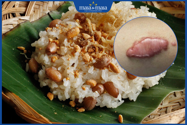 Ăn xôi có bị sẹo lồi không? Tư vấn dinh dưỡng ngừa sẹo lồi 2 xôi gây sẹo lồi