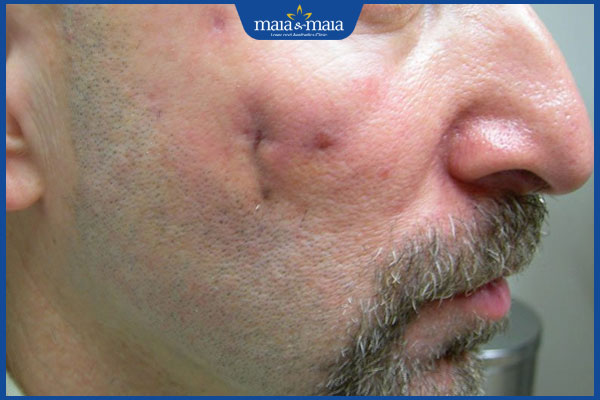 Cơ chế hình thành sẹo lõm do tai nạn & cách làm đầy hiệu quả 2 bị sẹo lõm do tai nạn